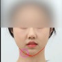 무턱 체부 볼륨의 중요성 : 뒤집어진 오메가 형태의 턱 라인과 턱끝함몰의 원인 Inverted Omega shape Deformity