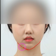 무턱 체부 볼륨의 중요성 : 뒤집어진 오메가 형태의 턱 라인과 턱끝함몰의 원인 Inverted Omega shape Deformity