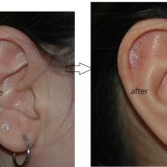 귀켈로이드 수술 사진 191