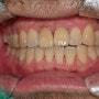죽전치과, 치아미백의 종류와 과정에 관하여