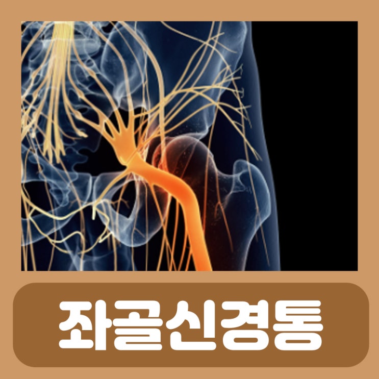 좌골신경통 치료 방법 원인 증상 스트레칭 좌골신경 : 네이버 블로그