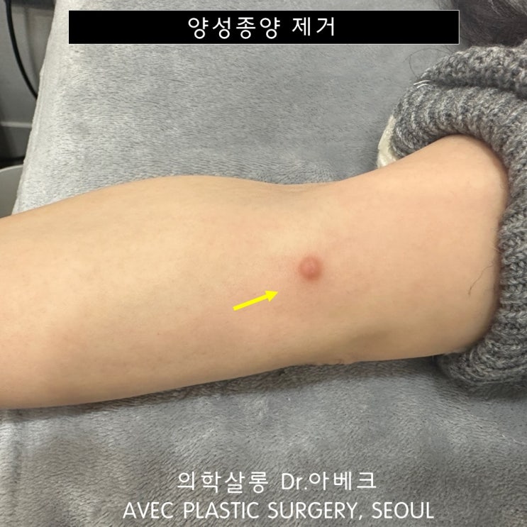팔, 다리에도 생기는 피부섬유종 제거 수술 【Dr. 아베크 양성종양】 : 네이버 블로그