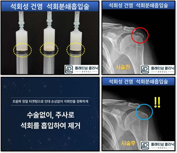 어깨 석회성 건염은 신사역 강남 정형외과 플래티넘의원에서. 석회분쇄흡입술로!!