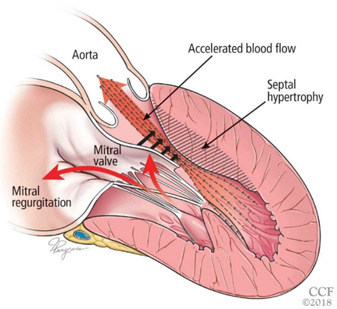 #비대성심근병증 Hypertrophic cardiomyopathy 이란? HCMP 환자에서 마취시 고려해야할 것 #심근병증마취 ...
