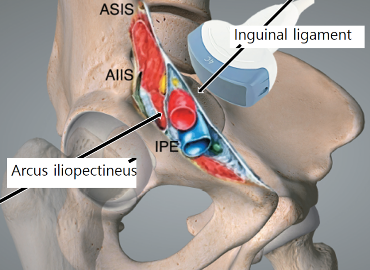 pericapsular nerve group block / #peng block 이란? #peng마취 : 네이버 블로그