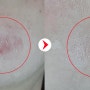 [흉터전문피부과]턱부위 브이빔프리마, 포토나토닝 딱 2번으로 해결,전후사진 비교