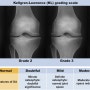 무릎 퇴행성관절염 등급 분류기준 (K-L grade)
