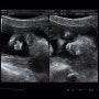 [디나제제의 임신 일기] 임신 24주차 기록, 임당검사&빈혈수치