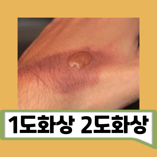 1도화상 2도화상 구별 및 치료 방법 올바른 밴드 사용법 : 네이버 블로그