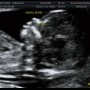 임신12주 13주 14주 기형아검사 니프티 검사 정밀 초음파 코뼈 목투명대 측정 아기 크기 및 신체변화 증상 안정기 임산부 필라테스 배나오는 시기