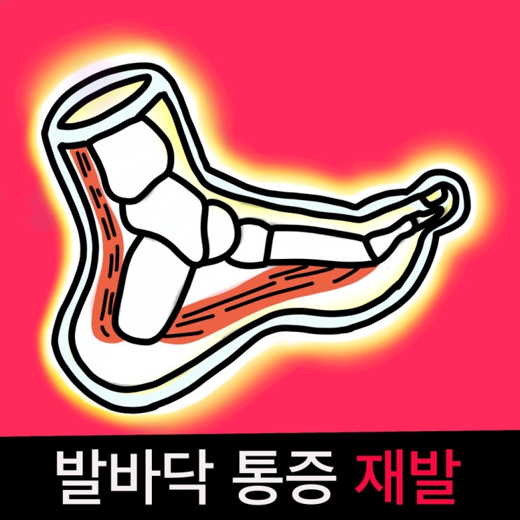 발바닥 발 옆날 통증 재발 이것만 하세요 (찐후기) : 네이버 블로그