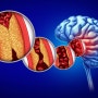뇌졸중과 편마비 치료