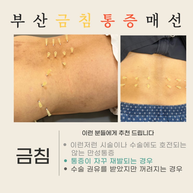 연산동한의원 : 통증 치료의 새로운 접근, 금침 매선요법 : 네이버 블로그