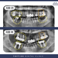 철산치과잘하는곳 양측어금니에 임플란트를!