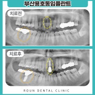 부산용호동임플란트 앞니파절과 어금니의 염증으로