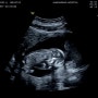 임신 13주~14주차 후기 (아기성별? 초음파 아기엎드린자세)
