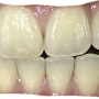 누렁니 탈출기 2화 | Crest Sensitive 크레스트 민감용 치아미백제 이용후기 (일주일차)