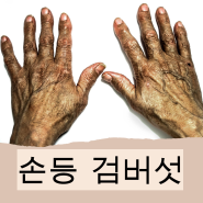 손등 검버섯 원인 치료, 예방