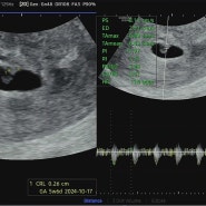 [시험관 기록] 임신 5주 6일 난황, 심장소리 확인