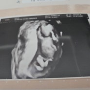 [임신일기] 임신 13주 2차 기형아검사,1차입체초음파