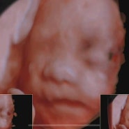 임신29주 - 정밀입체초음파, 시그바리스압박스타킹 구입