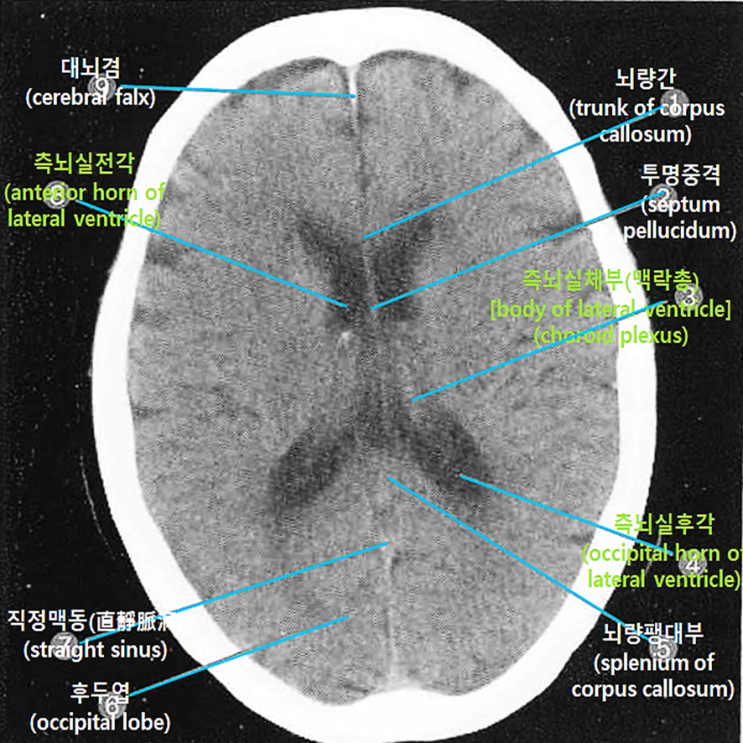 Brain_CT image_33: 뇌량 결손증(callosal agenesis) : 네이버 블로그