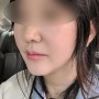 [유캔비성형외과] 안면거상 2개월 경과