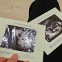양수과소증 입원 사산 후 몸조리 태반조기박리 22주 제왕절개 수술로 마무리된 임신