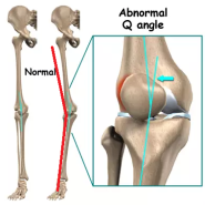 [무릎] 연골은 멀쩡한데 무릎이 아픈이유? 습관으로 인한 근육문제!
