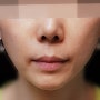 [유캔비성형외과] 안면거상,하안검 1개월 경과