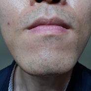 [리얼 후기 3탄] 남자 수염 레이저 제모 젠틀맥스프로 영등포 노벨의원 내돈내산
