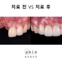 앞니 잇몸 푹 꺼진 경우, 잇몸이식 후 브릿지 치료 (앞니 재치료)