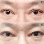 쌍수소세지눈 나에게 적합한 수술방법은?