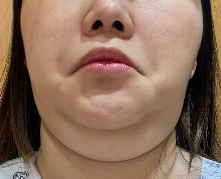 인모드랑 리프테라 리프팅 같이 시술받은 후기 : 네이버 블로그