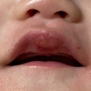 [육아정보] 입술 안쪽 찢어짐, 아기가 넘어져서 입술 안쪽에 피가 나요