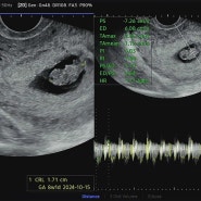 [시험관 기록] 임신 7주 6일 초음파, 입덧지옥, 임밍아웃