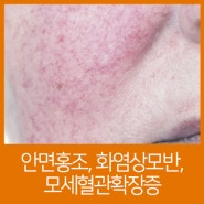 청주피부과, 얼굴 붉음증? 안면홍조-모세혈관확장증-화염상모반 증상과 차이점