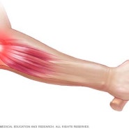 중계동 한의원. 팔꿈치통증 테니스엘보통증(골프엘보통증) 어떻게 치료해야할까요?
