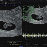 [시험관 기록] 임신 6주 6일 초음파, 입덧 시작
