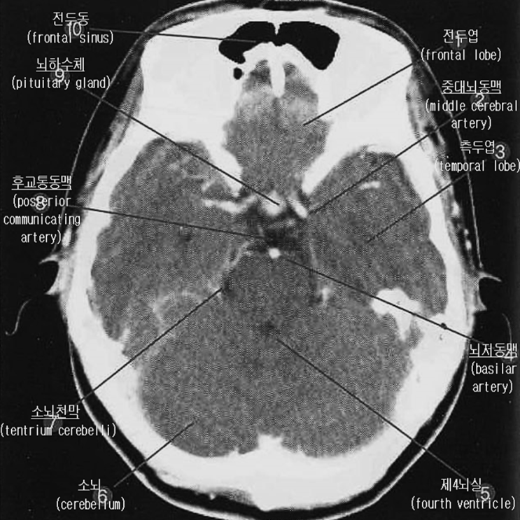 Brain_CT image_41: 급성 MCA (중대뇌동맥) 경색 : 네이버 블로그