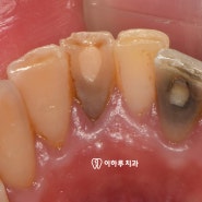 신촌치과 변색된 아래 앞니, 치아 뿌리 염증, 재 신경치료 후 크라운