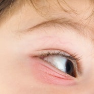 해운대안과, 눈 가려운 증상이 잦은 결막염