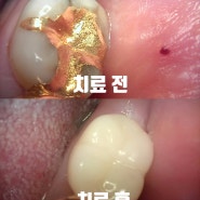 감일치과, 감일동 치과, 심하게 금이 간 치아, 균열 치아, Crack tooth 치료 증례