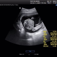 임신 23주 차 특징 및 증상 : 붓기, 피부트러블