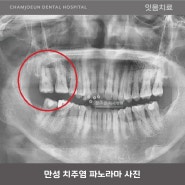 청주 잇몸치료 방법 스케일링과 치근단활택술