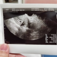 [임신일기_01] 복통으로 병원가니 임신이었던 ssul/ 임신4,5주차 증상