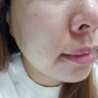 얼굴부위별 여드름원인 (성인 이마, 코, 볼, 턱밑, 입 여드름 부위별 원인)