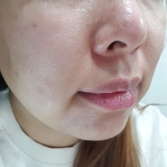 얼굴부위별 여드름원인 (성인 이마, 코, 볼, 턱밑, 입 여드름 부위별 원인)