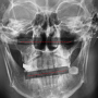 안면비대칭, 무턱 원인 턱관절염 분석, 턱관절 과두 X-ray 보는법