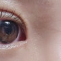 [청주쌍수] 비절개 눈매교정 + 앞트임 찐찐 후기 (수술 당일 ~ 한 달)